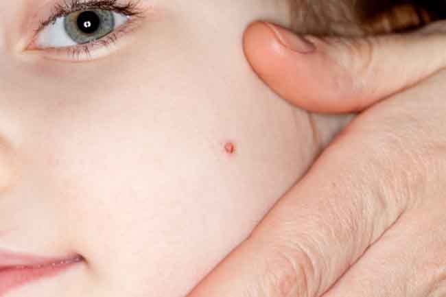मस्सों के रोकथाम के उपाय